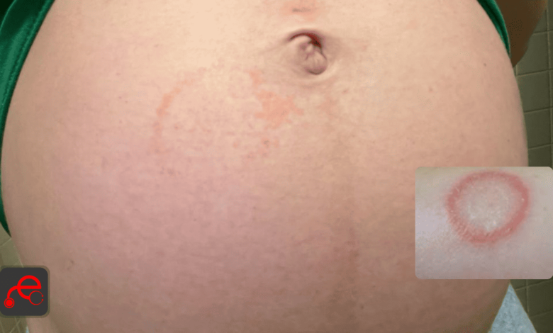 Ringworm-During-Pregnancy